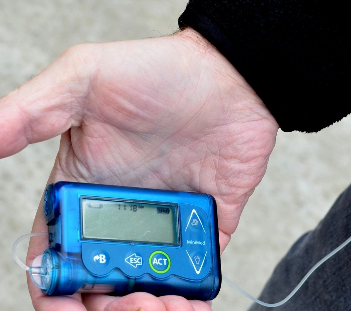 insulin pump