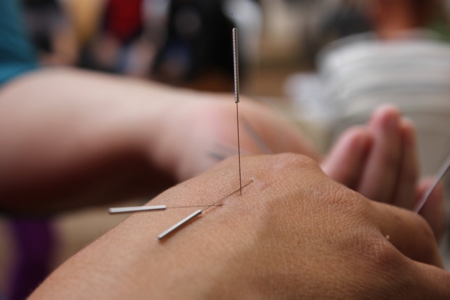 acupuncture